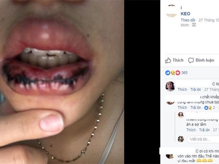 Biến chứng nguy hiểm khi phẫu thuật tạo hình môi