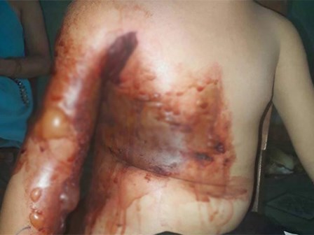 Nghịch dại bé 5 tuổi bỏng nặng, mẹ thiếu tiền đành cho con xuất viện sớm để dùng thuốc nam khiến con bị hoại tử