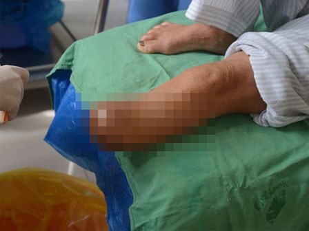 Căn bệnh đang âm thầm đe dọa tính mạng hơn 400 triệu người