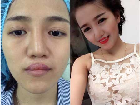 Phẫu thuật thẩm mỹ thành công, cô gái trẻ hạnh phúc sau bao năm