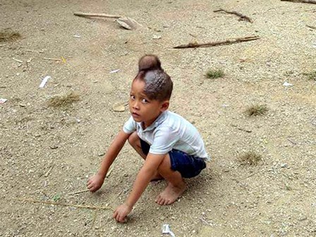 Bé trai 5 tuổi có khối u kì dị mọc trên đỉnh đầu, bố mẹ quá nghèo chờ mãi mới đưa con đi khám