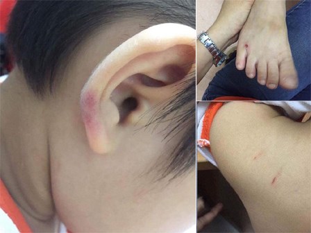 Phẫn nộ trước cảnh cô giáo mầm non hành hạ con riêng của chồng ở Hà Nội