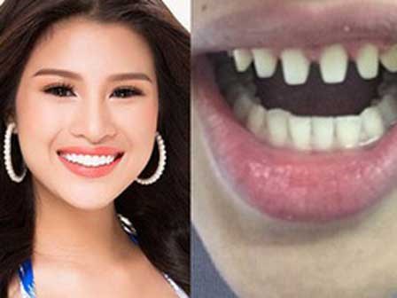 Nếu tháo hết răng sứ, liệu có ai dám nhìn Nguyễn Thị Thành khi cười?
