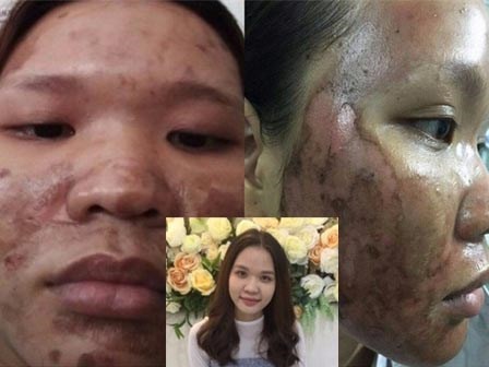 Dùng kem trộn, một phụ nữ bị