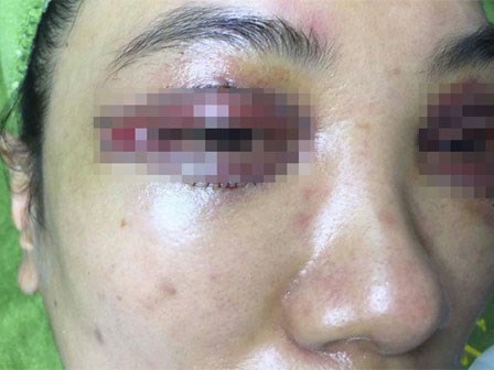 Xử phạt spa cắt mí hỏng khiến mắt khách hàng chảy máu