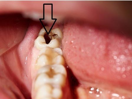 Tìm thấy 1 thực phẩm ngừa sâu và làm trắng răng an toàn, hiệu quả hơn cả kem thông thường