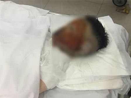Thiếu nữ 17 tuổi bị tạt axit trên đường tan ca làm về