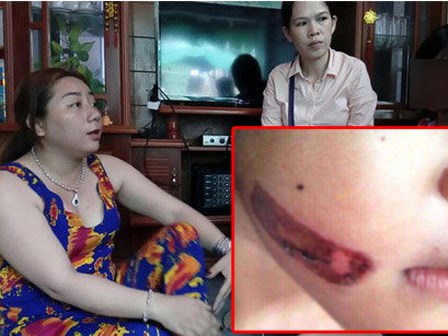 Bé 7 tuổi bị bạo hành bằng sắt nung đỏ: Mẹ kế nói vết bỏng do dầu mỡ văng trúng