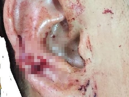 Nhậu say trở về nhà, chồng bị vợ chém đứt vành tai, gân chân rồi dẫn đi băng bó