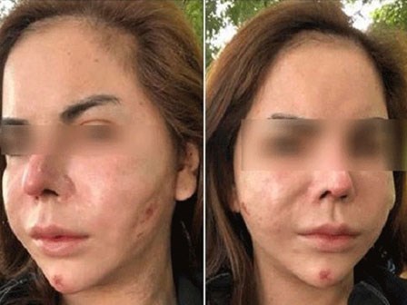 Đừng dại tiêm silicon giống hot girl chuyển giới Linda, mặt sẽ dần biến dạng và không bao giờ lấy ra hết được