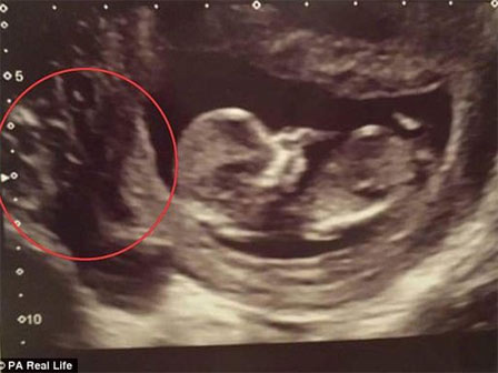 Siêu âm phát hiện nhau thai có chấm đen bí ẩn, bác sĩ cảnh báo mẹ bầu nên cẩn thận với điều này-2