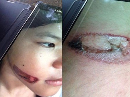 Vụ bé gái nghi bị cha dí thanh sắt nóng vào người: Cách ly khỏi cha ruột và mẹ kế