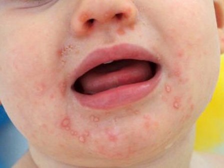 Cách điều trị bệnh tay chân miệng tại nhà giúp bé nhanh khỏi