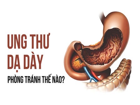 Tất cả về ung thư dạ dày: Biết để tránh xa căn bệnh nguy hiểm, dễ tái phát
