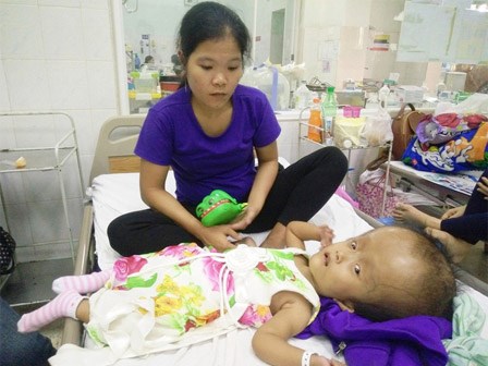 Xót cảnh bé gái 4 tuổi bị não úng thủy, đầu to gấp ba lần người thường mà bố mẹ nghèo không tiền chạy chữa