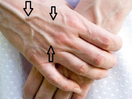 Nên làm gì khi thấy những gân xanh nổi trên người: Giáo sư Anh chia sẻ cách xử lý