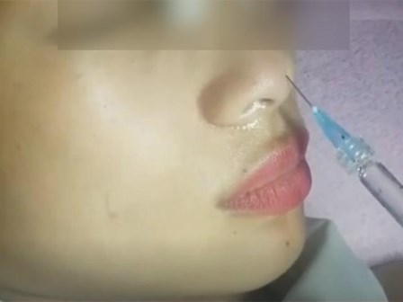TP.HCM: Cô gái khởi kiện cơ sở thẩm mỹ vì hỏng mắt sau tiêm chất làm đầy mũi