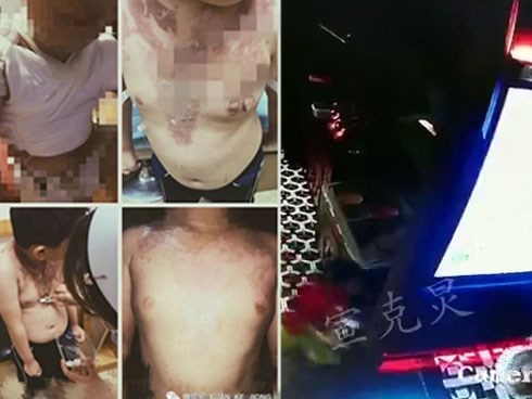 Chạy nhảy trong nhà hàng, bé trai giãy dụa đau đớn khi bị cả nồi nước lẩu đổ vào người