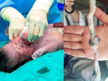 Vừa đón em bé chào đời, bác sĩ hét lên 