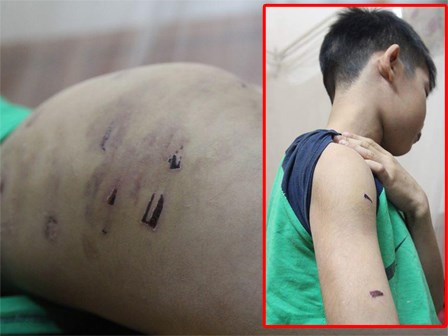 Hà Nội: Bé trai 9 tuổi bị điểm kém, bố dùng dây điện bạo hành dã man