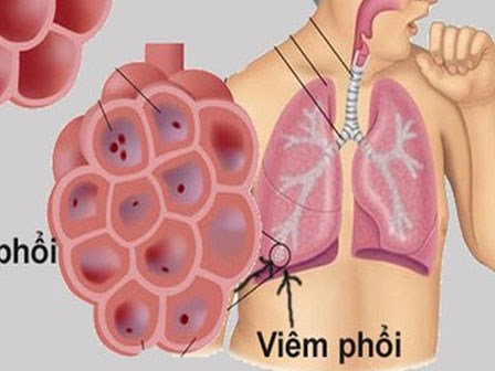 Căn bệnh gây tử vong hàng đầu ở trẻ, cha mẹ cần nhớ các dấu hiệu điển hình này