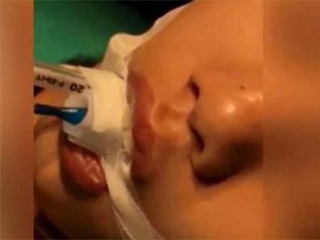 Bé gái 10 tuổi suýt chết vì để mẹ nặn mụn đầu đen