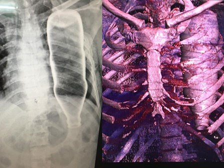 Hy hữu nhất 2017: Bật dậy khi đang lo ma, chai chui tọt lồng ngực