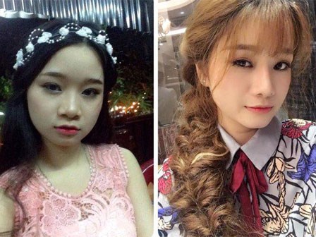 Nhật kí cắt mí mắt của cô nàng 9x từng lo sợ mắt sẽ bị 