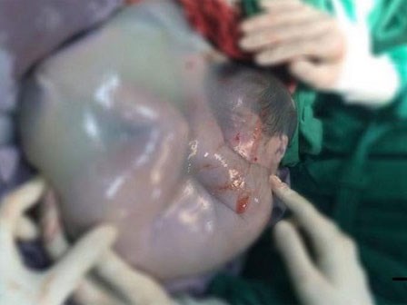 TP.HCM: Bé gái song sinh ra khỏi bụng mẹ vẫn còn nguyên trong bọc ối, 80.000 ca mới có một