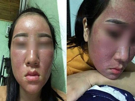 Công bố danh sách những loại kem dưỡng trắng hủy hoại da không kém gì kem trộn