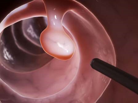 4 nhóm người buộc phải khám ung thư để tiêu diệt mầm bệnh ngay từ trong 'trứng nước'