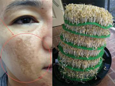 Bị nám da, cứ lấy nắm giá đỗ và củ cải làm thế này sau 2 tuần là sạch bách-10