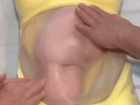 Tròn mắt xem bác sĩ dùng 2 tay xoay ngôi thai từ ngôi ngược thành ngôi thuận chỉ trong chưa đầy 1 phút-9