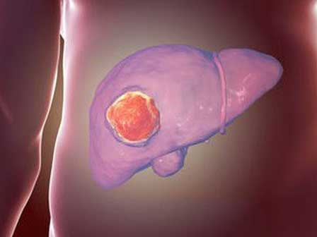 Cảnh giác sớm với 8 hành vi có thể khiến tế bào ung thư gan phát triển nhanh chóng