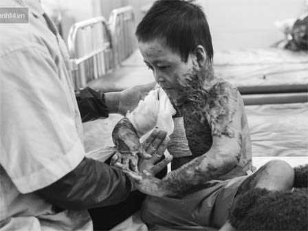 Xót xa những vết bỏng đau đớn trên người bé trai 6 tuổi: Ngày con phải cưa chân là ngày bạn bè vào lớp 1