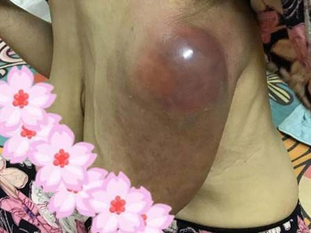 Rước họa vì bài thuốc chữa ung thư vú truyền miệng