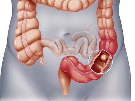 Tắc ruột do u đại tràng