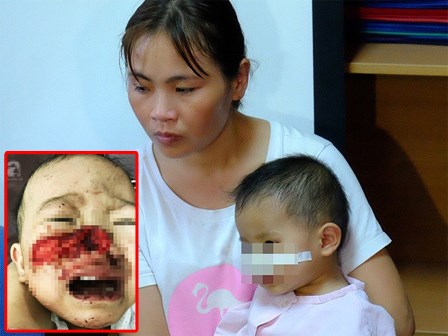 Mẹ lo làm việc dưới bếp, con trai bị chó nhà cắn thủng khí quản