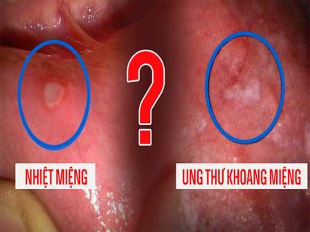 Phân biệt nhiệt miệng và ung thư khoang miệng: Chú ý 3 điểm sẽ tránh hậu quả nghiêm trọng