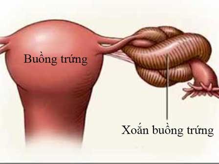 Nữ giới có nguy cơ cao bị xoắn buồng trứng nếu thuộc một trong những đối tượng sau-4