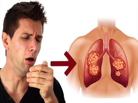 Ho trong bao lâu thì bạn nên đi khám để phòng ngừa bệnh ung thư phổi?
