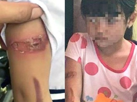 Bé gái bị bố đẻ mẹ kế bạo hành 