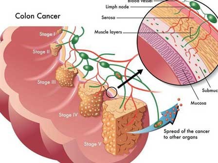 95% ca ung thư đại tràng liên quan đến nguyên nhân này, làm sao để phòng bệnh đúng cách?