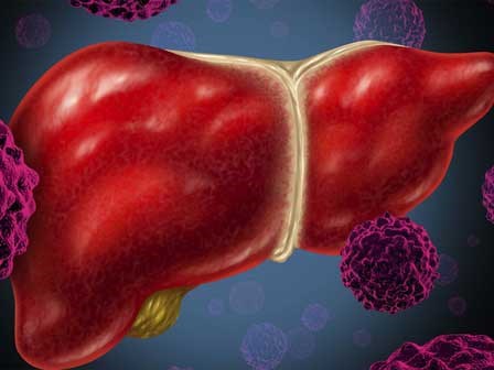 Những nhóm người dễ mắc ung thư gan hơn người khác: Hãy đề phòng!