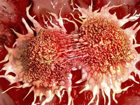 Không ăn thịt đỏ cũng có thể bị ung thư trực tràng: Hãy cảnh giác với những lý do này