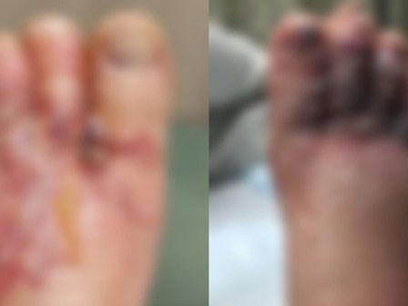 Đi chân trần trên biển, cặp vợ chồng kinh hãi khi thấy đôi chân sưng phồng, chuyển màu đen tím