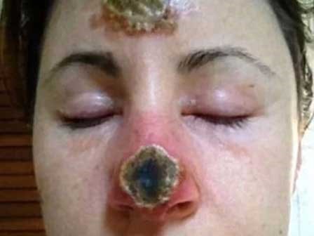 KHIẾP SỢ: Mũi thủng lỗ khổng lồ chỉ vì dùng thuốc mỡ sai cách
