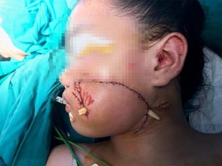 Chơi đùa với chó, bé gái 8 tuổi bị cắn biến dạng mặt