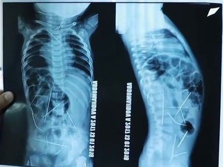 Con sốt cao, tiểu tiện khó khăn, mẹ đưa đến bệnh viện và ngã quỵ khi nhìn thấy hình chụp X-quang