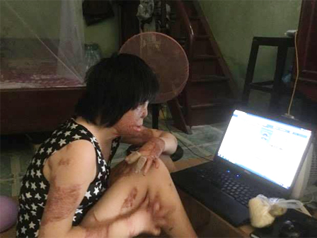 2 cô gái bị chồng đốt tựa vào nhau tìm lại hình hài-3